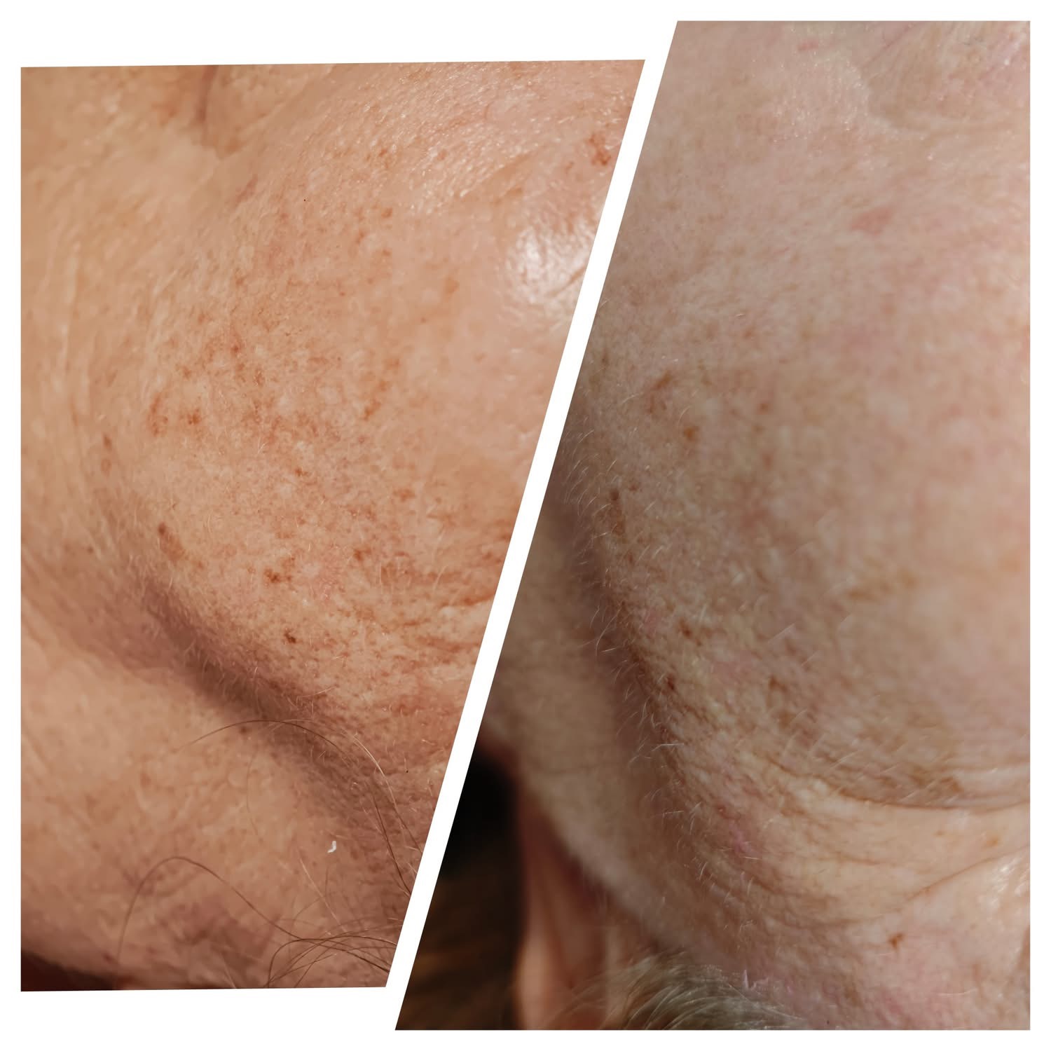 Efekt zabiegu Bloomea 2