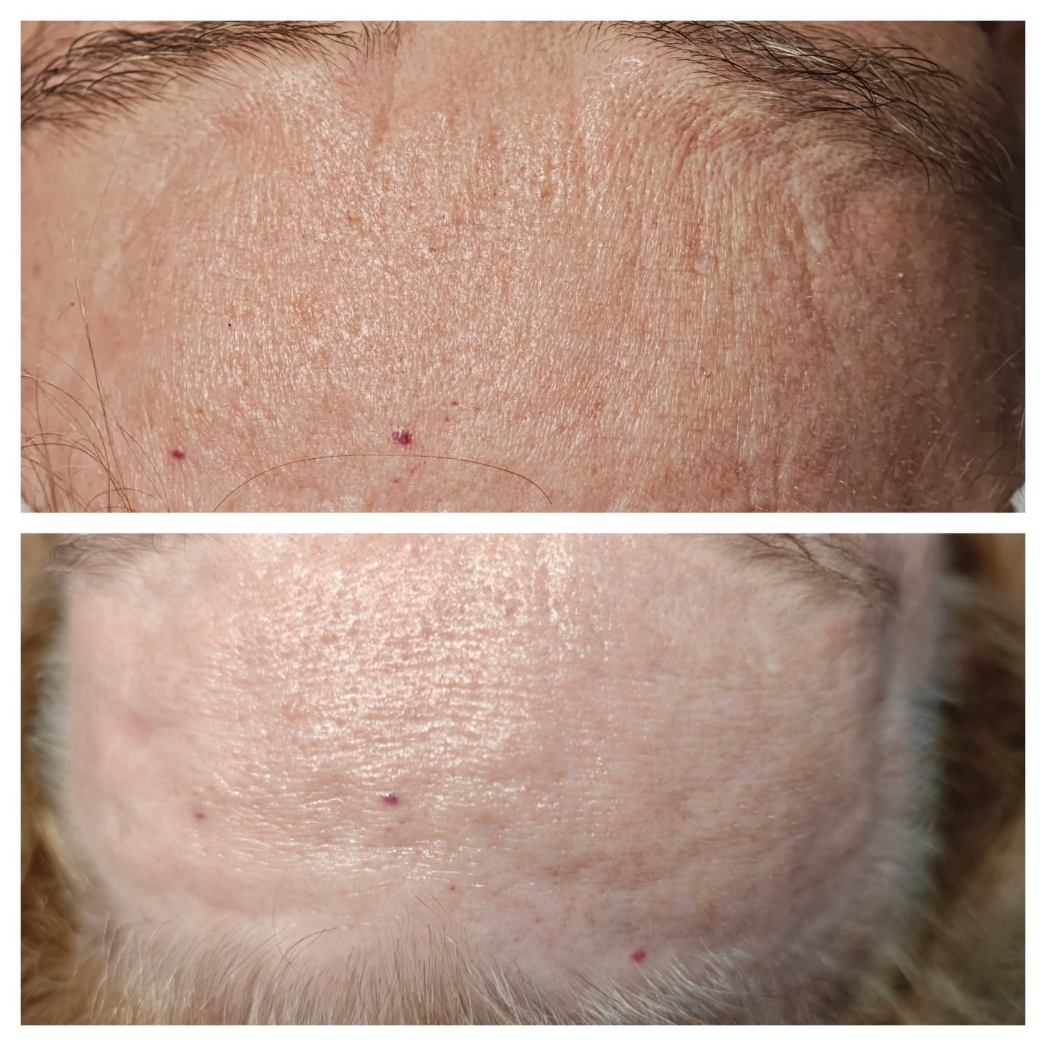 Efekt zabiegu Bloomea 4