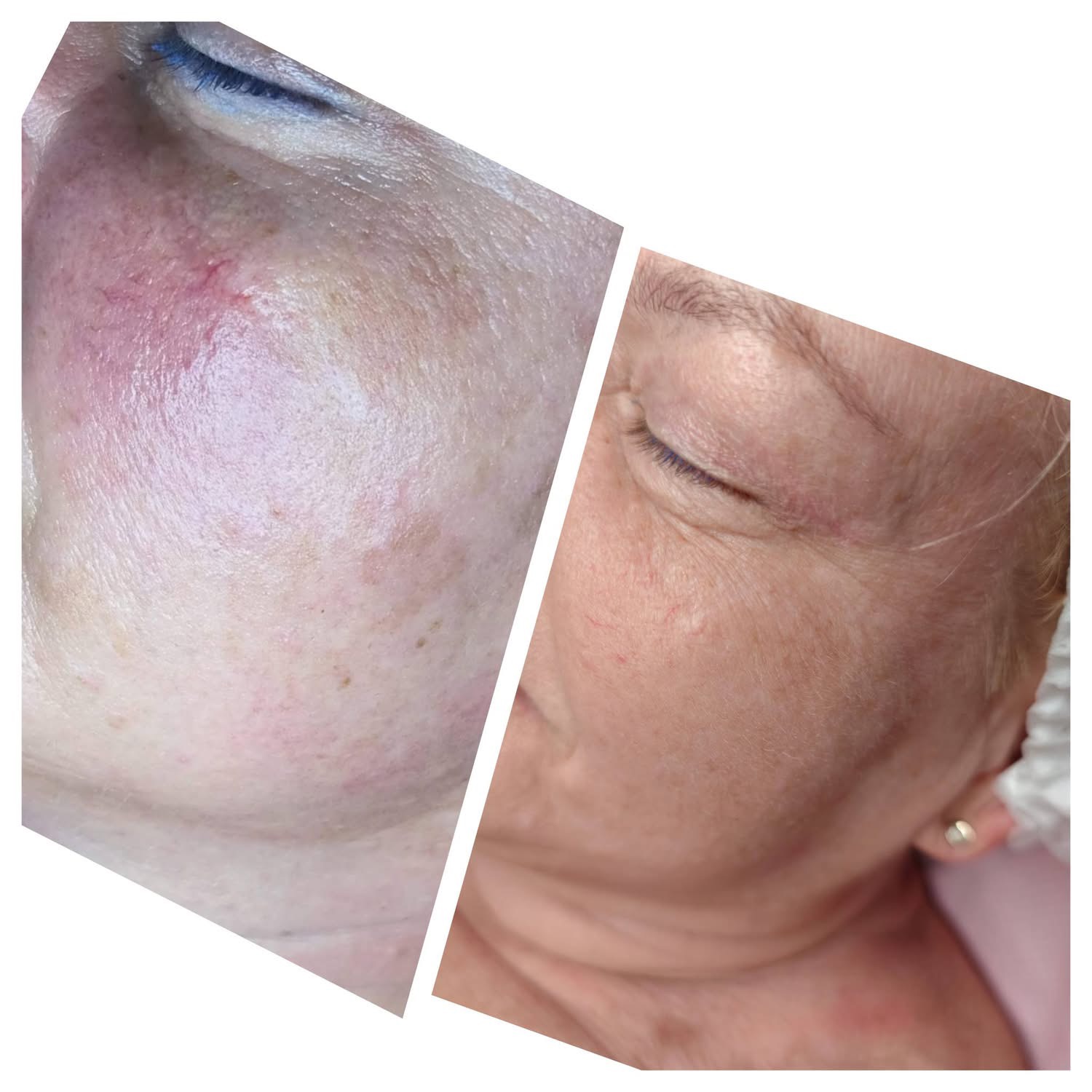 Efekt zabiegu laserowego 1