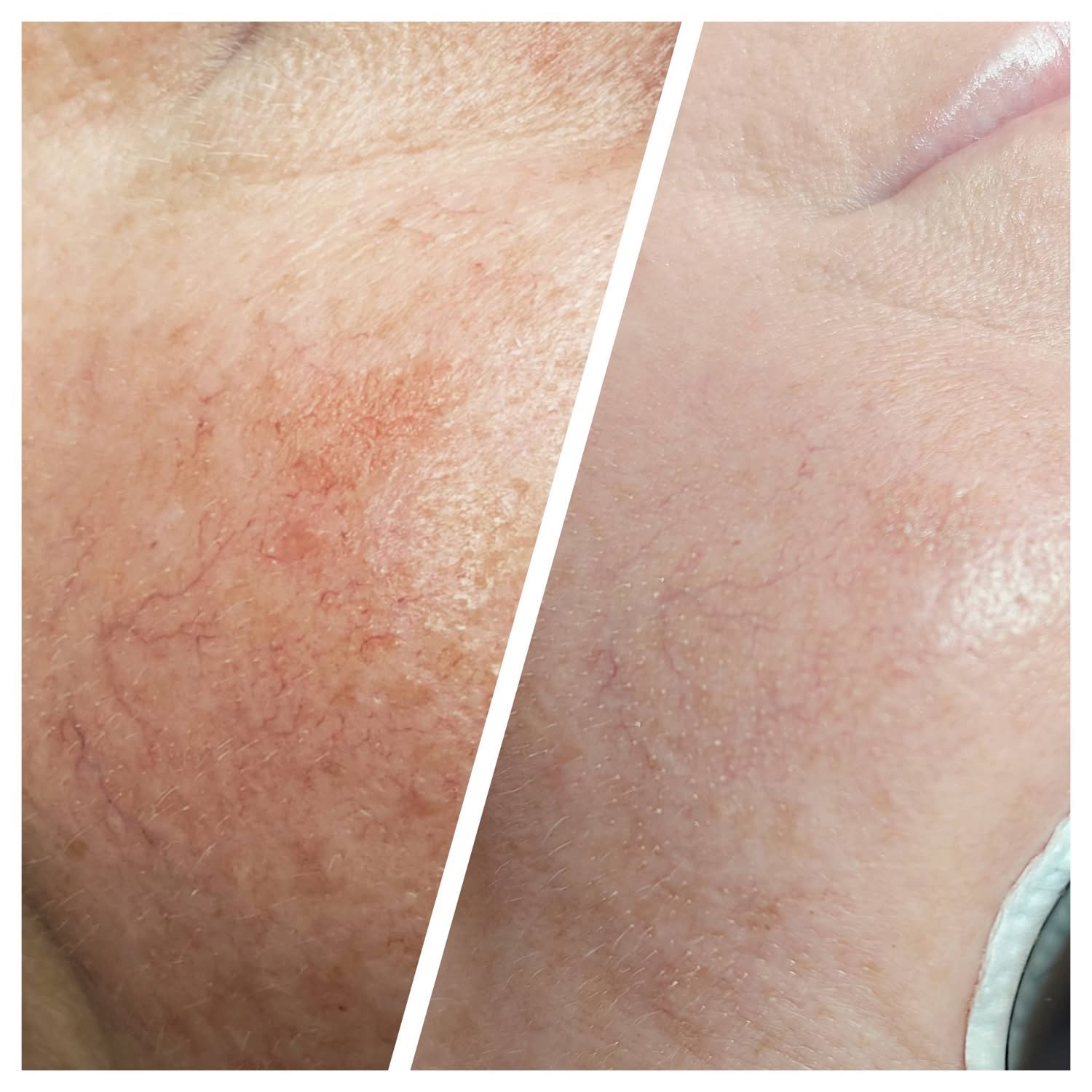 Efekt zabiegu laserowego 4